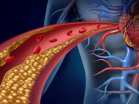 Vì sao tình trạng Cholesterol trong máu luôn cao bất thường?