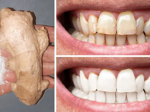 8 cách đơn giản giúp bạn sở hữu hàm răng trắng tinh thu hút mọi ánh nhìn mà không cần đến nha sĩ