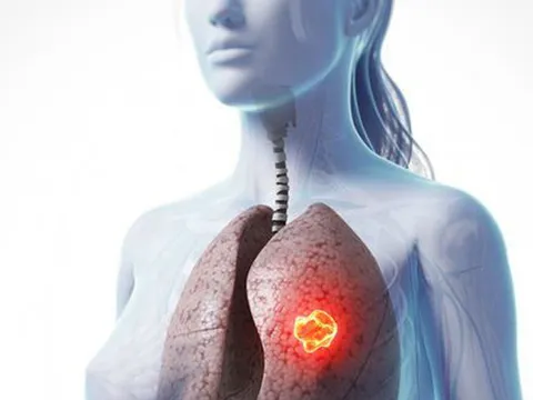 Phụ nữ có khả năng sống sót cao hơn sau phẫu thuật ung thư phổi